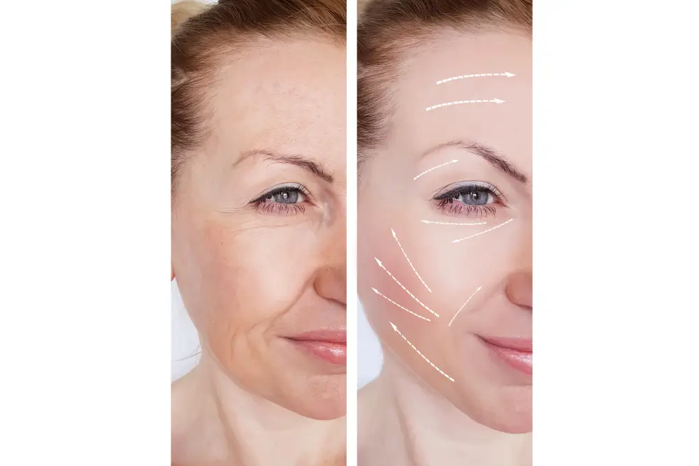 Wrinkle-Reducing Benefits